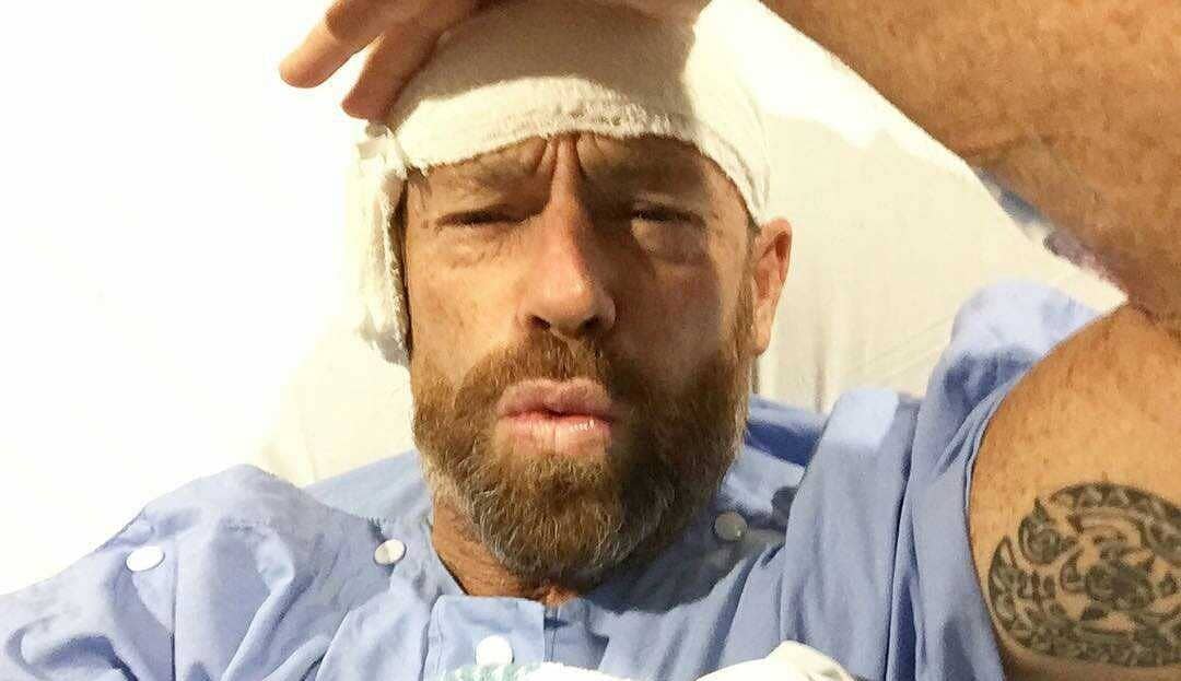 Image of Tom Carroll after his operation removing surfer’s ear