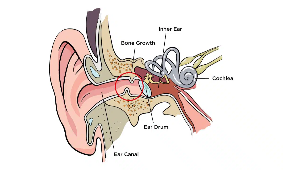An illustration showing affected area of surfers ears