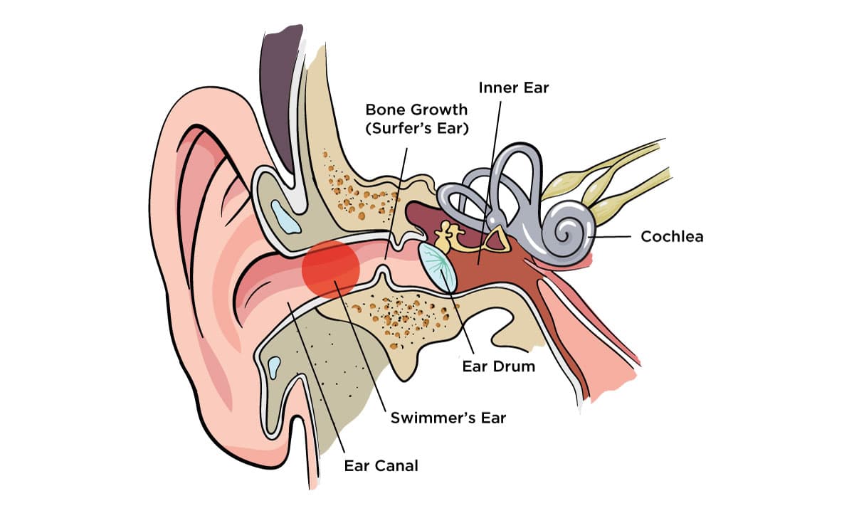 An illustration showing affected area of swimmers ear