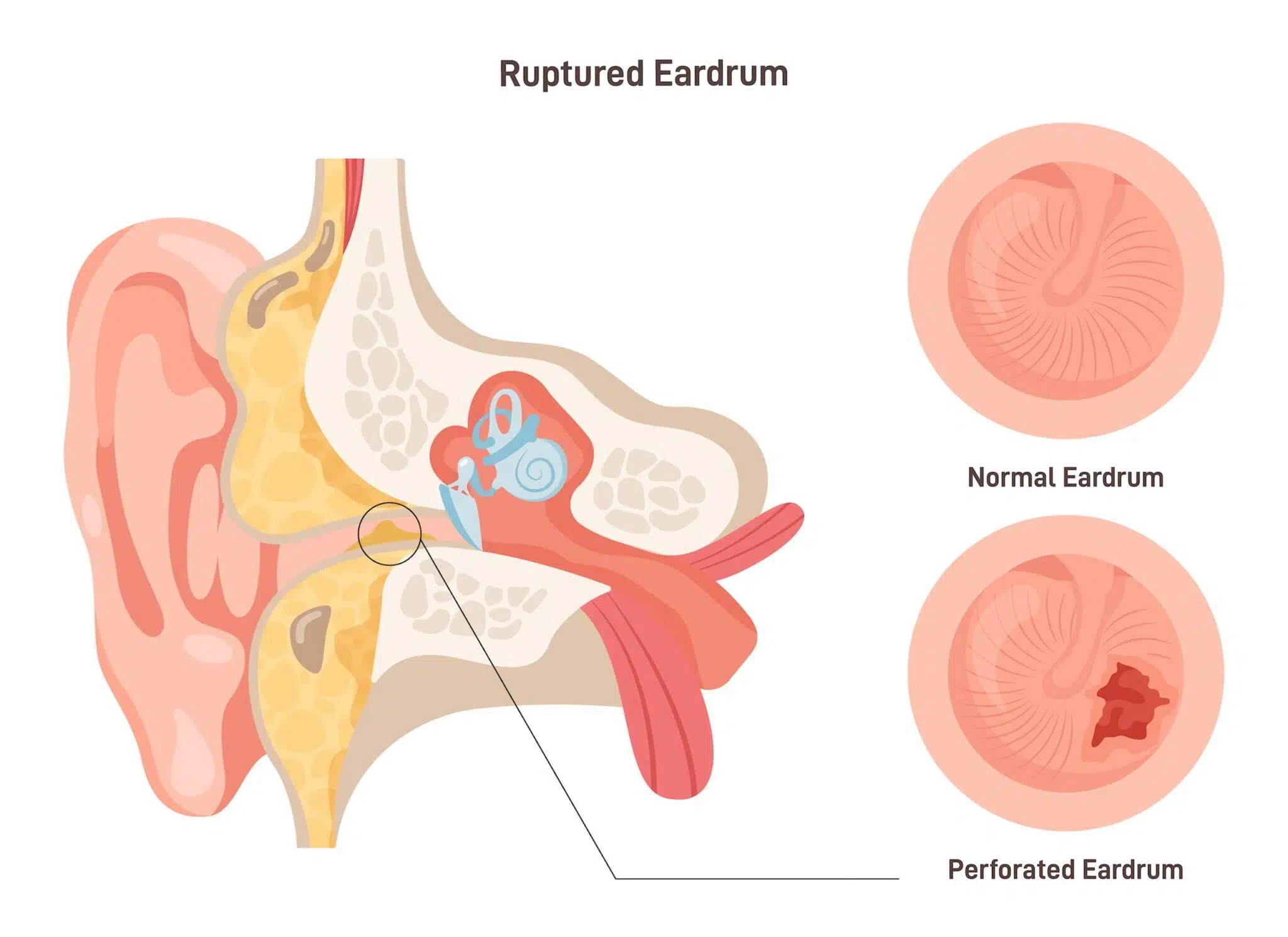 Diagram comparing a normal eardrum to a perforated eardrum